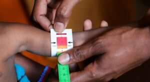 Somalia child malnutrition