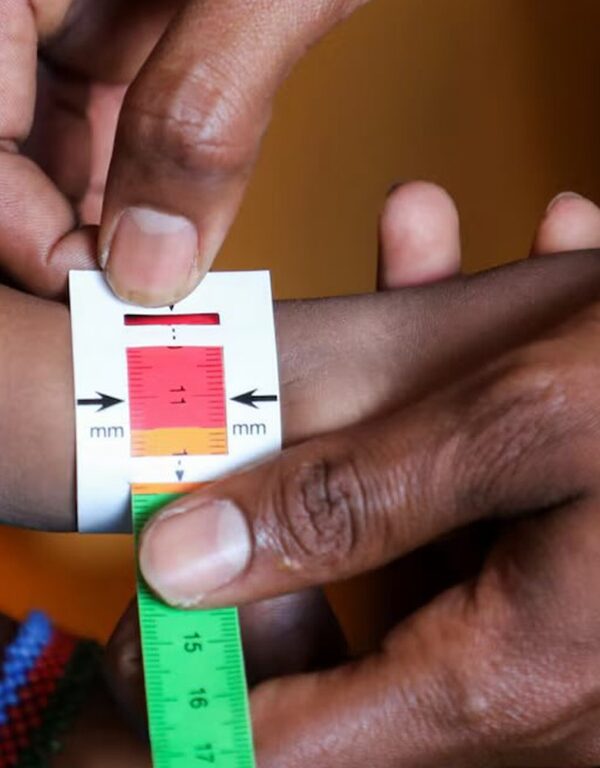 Somalia child malnutrition